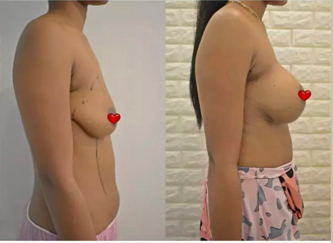 Breast Augmentation Bangalore Before and after