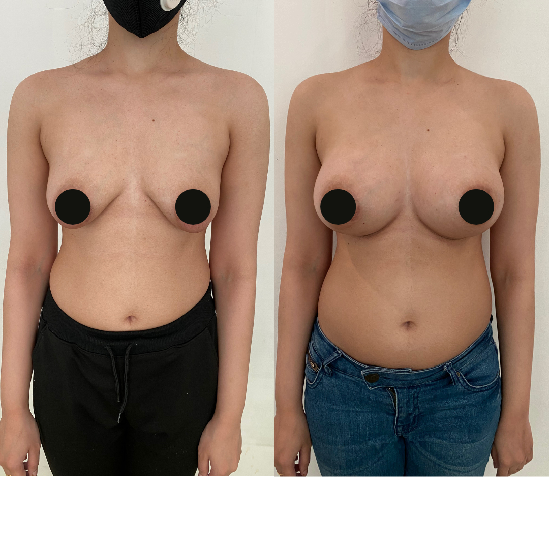 Breast Augmentation Surgeon Before and after