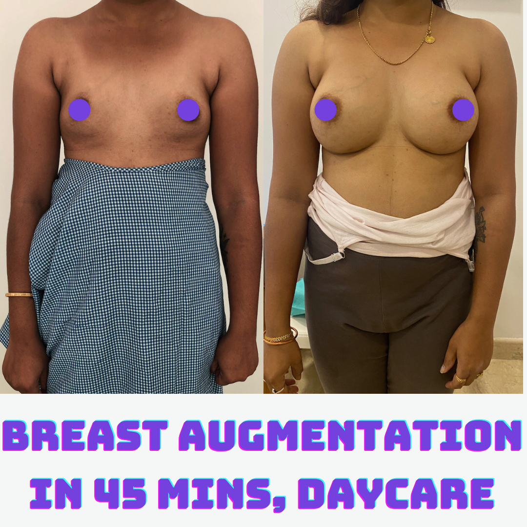 Breast Augmentation Bangalore Before and after