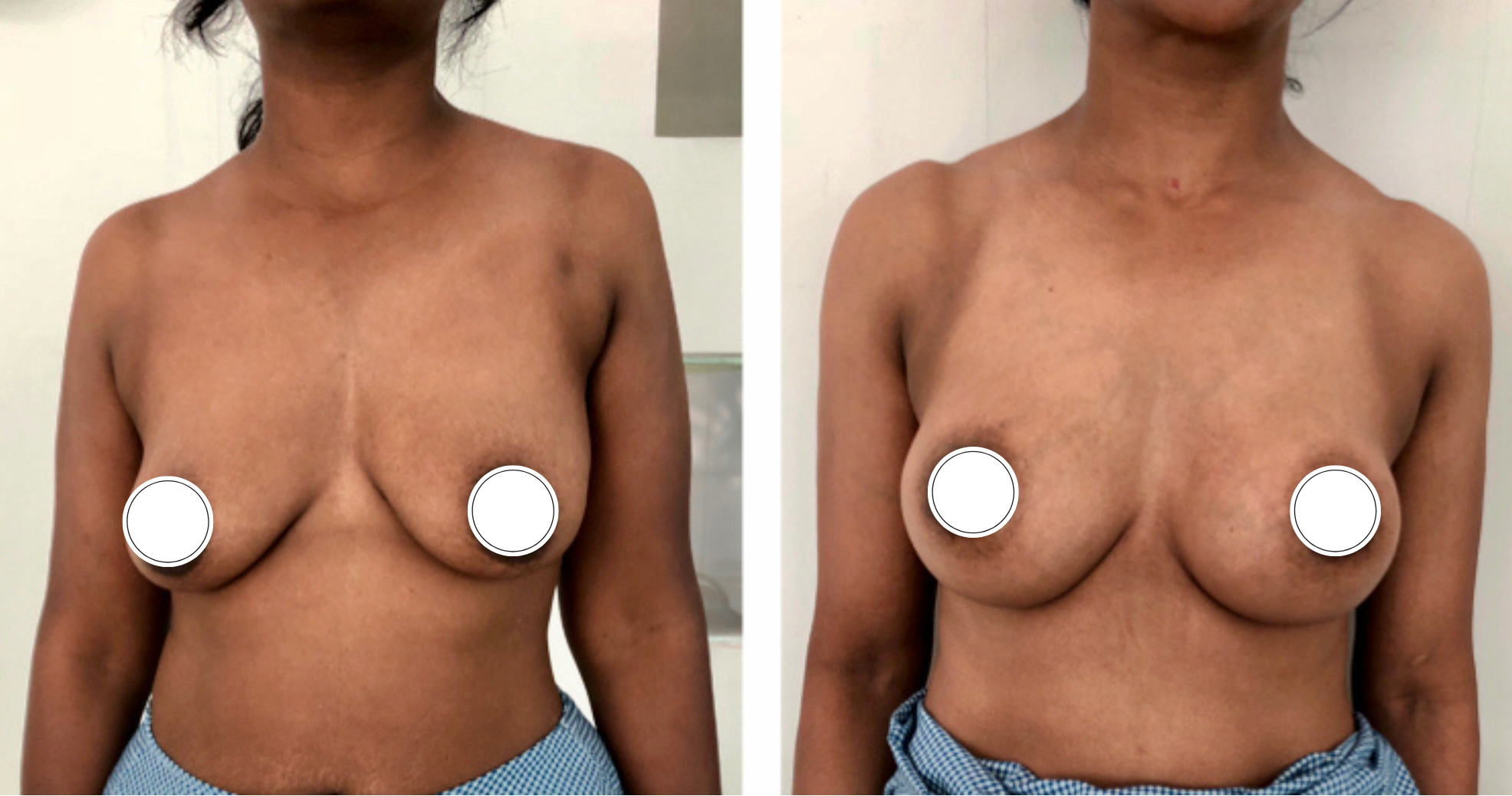 Breast Augmentation Bangalore Before and after Pictures
